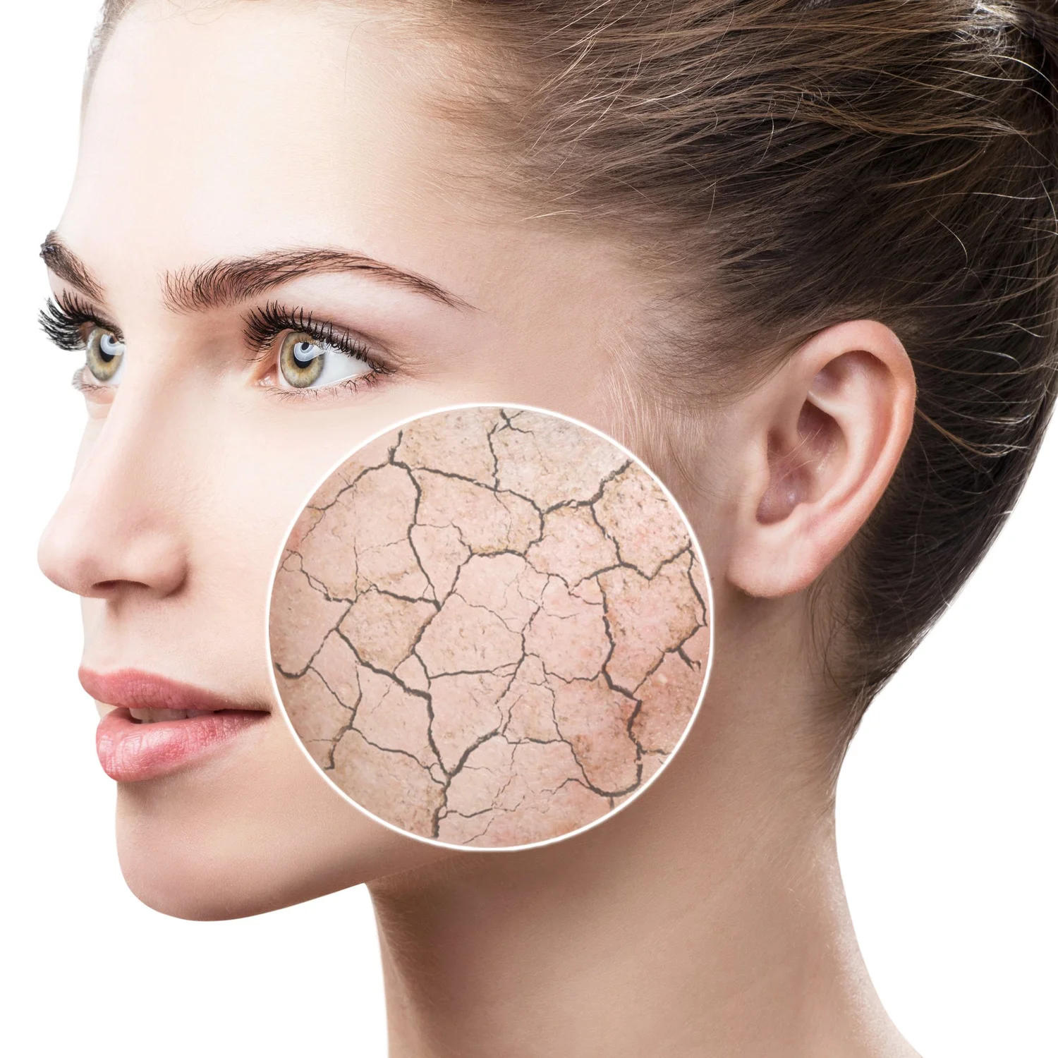 Radiesse filler
